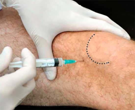 Tratamiento de infiltración de rodilla con ácido hialurónico - Procedimiento no quirúrgico